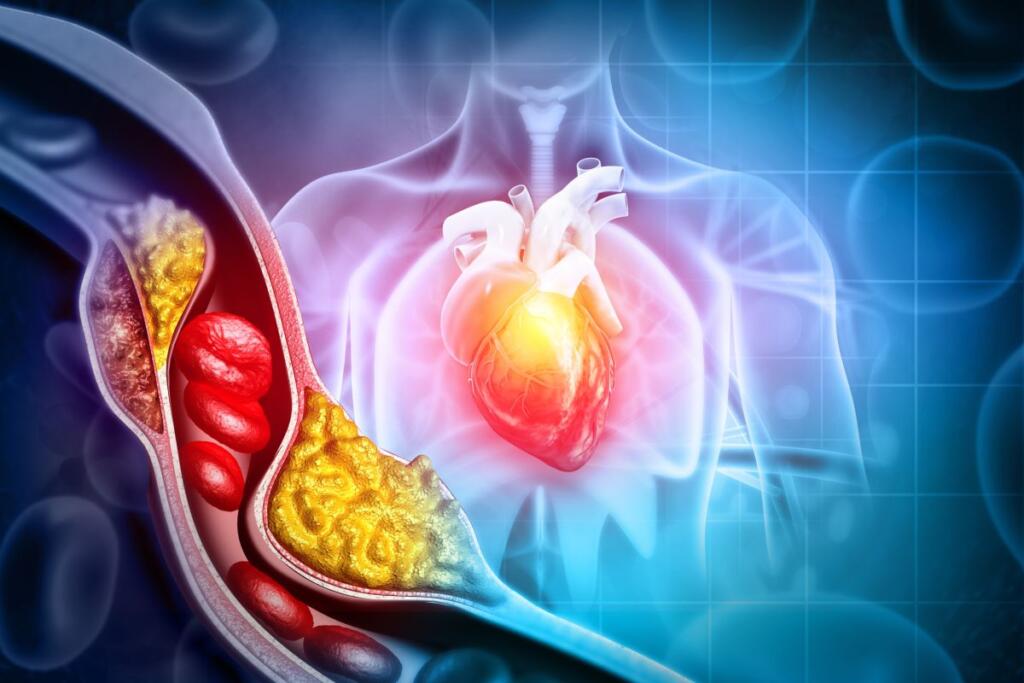 colesterolo blocca arteria cuore