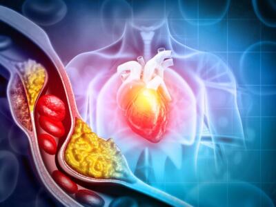 Colesterolo blocca arteria