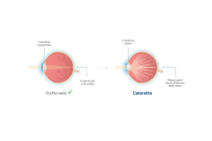 Illustrazione occhio sano e con cataratta