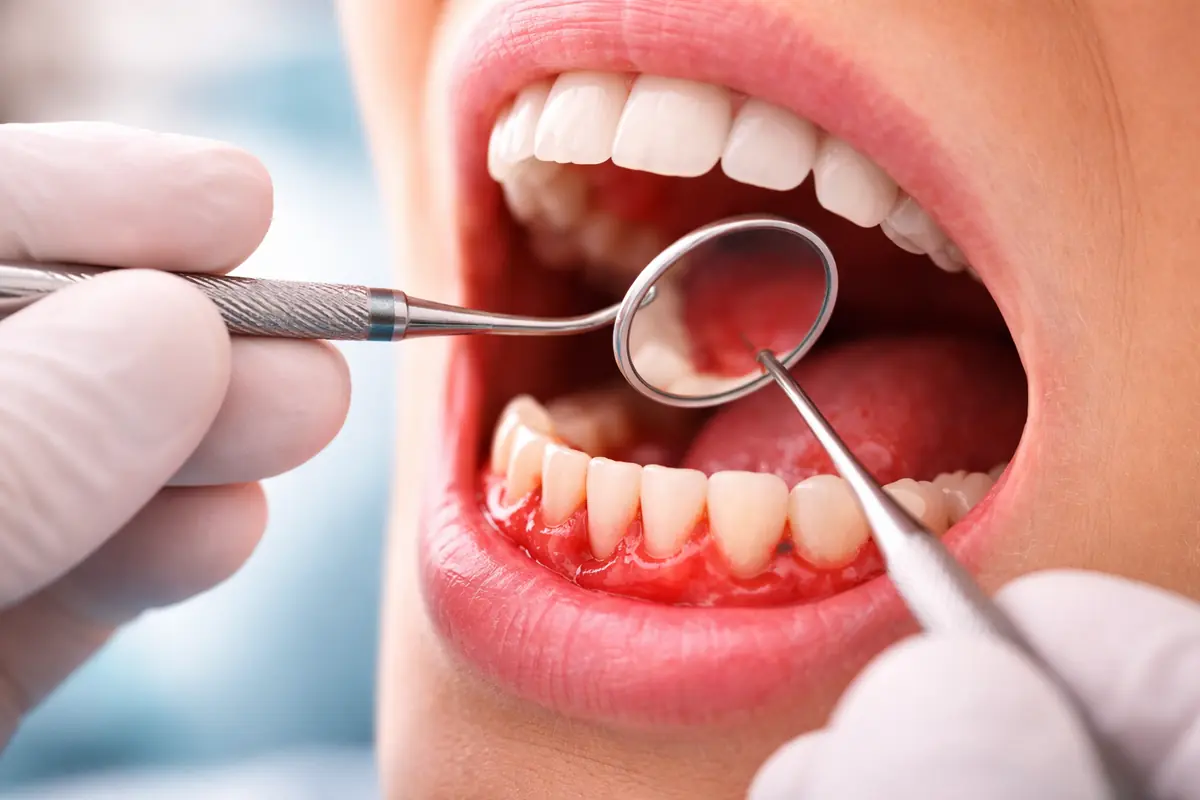 Gengive infiammate e sanguinanti durante visita dal dentista per parodontite